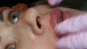 ГУБЫ(т-ф). Верхняя-,,развернуть и поднять,,-заход с линии смыкания