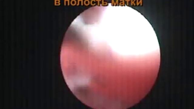 Возвращение «блудной» Мирены в матку. смотреть онлайн