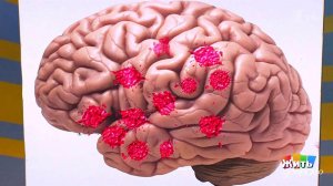 Тромбы-бомбы. Жить здорово! Фрагмент выпуска от 10.2017