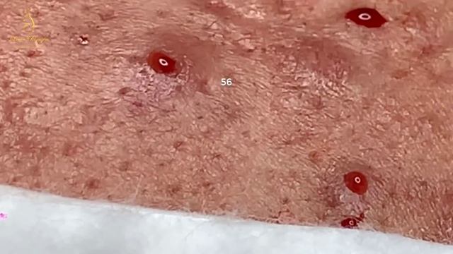 Get rid of BLACKHEADS for the LONGEST time, 44 minutes (56) | Loan Nguyen смотреть онлайн