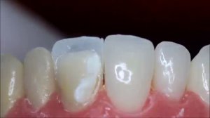 Реставрация зуба. Как это происходит.