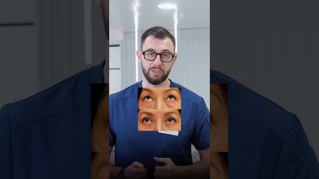 Блефаропластика азиатских глаз - что это такое? #блефаропластика смотреть онлайн