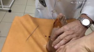 Снятие спиц из стопы после смещения плюсневых пальцев 1; 2; 3; 4.