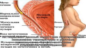 Острый пиелонефрит у детей