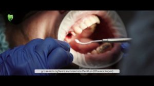 Установка дентального имплантата Дентиум в Сочи. Dentium (Южная Корея)
