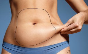 Жир после липосакции: вернется ли?