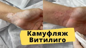 ВИТИЛИГО можно вылечить? Подбор пигментов, процесс камуфляжа витилиго и результат ДО/ПОСЛЕ.