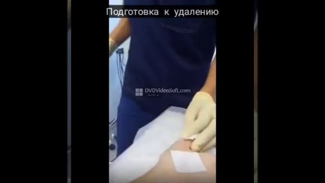 Удаление лазером новообразований на коже (родинок, бородавок, папиллом и других) смотреть онлайн