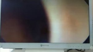 Эндоскопия носоглотки