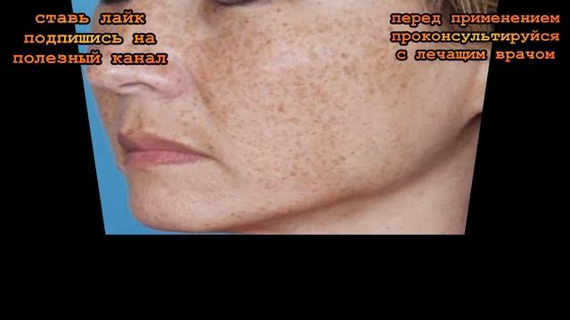 ★ 6 действенных средств для борьбы с пигментными пятнами. Твоя кожа обретет равномерный цвет! смотреть онлайн