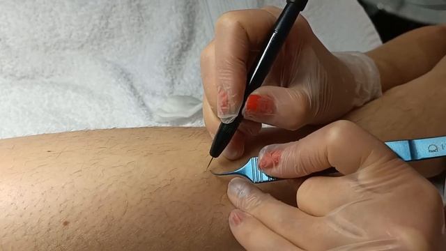 Как проходит процедура по электроэпиляции