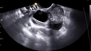 Дермоидная киста правого яичника