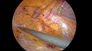 eTEP inguinal hernia repair