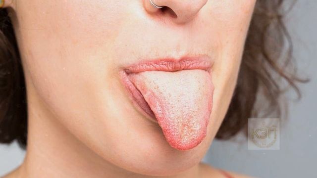 Если заметили белый налет на языке то сделайте так!!! Что значит белый налет на языке! смотреть онлайн