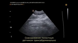 Аппендикулярный инфильтрат (22 -5 -18)