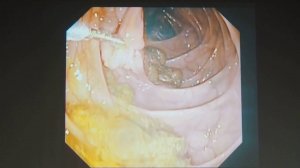 01 Алексеев КИ – Эндоскопическое удаление гигантской липомы толстой кишки двумя колоноскопами