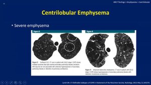 Imaging of Chronic Obstructive Pulmonary Disease (COPD)