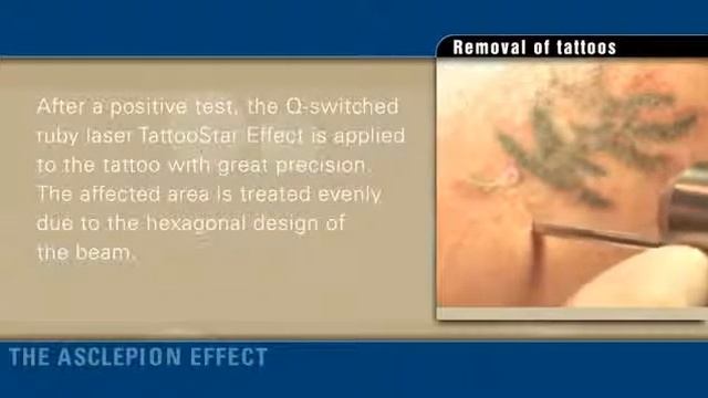 TattooStar EFFECT Удаление татуировок (laser-ms.ru) смотреть онлайн