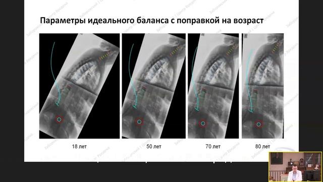 Реконструктивная спинальная хирургия Мифы и реальность.