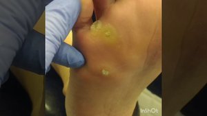 онлайн курс "ВПЧ бородавки". https://vk.com/podolog39