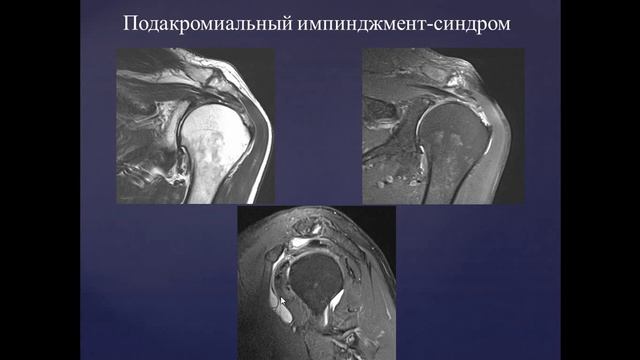Базовый курс по МРТ  b  Лекция «МР семиотика повреждений плечевого сустава»  Лектор  Учеваткин А А