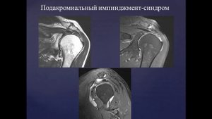 Базовый курс по МРТ  b  Лекция «МР семиотика повреждений плечевого сустава»  Лектор  Учеваткин А А