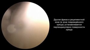 Мозаичная Хондропластика