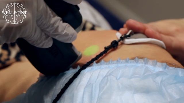 Wellpoint   06   Лазерная эпиляция смотреть онлайн