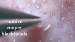 鼻角栓107.2nose blackheads(Larger version)★Tweezers only★