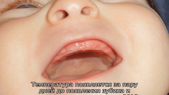 График прорезывания зубов у детей до года смотреть онлайн