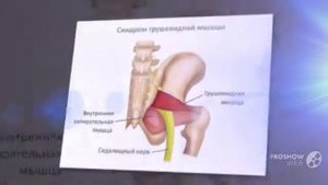 Боль в пояснице отдает в левую ногу ягодицу » spine боль в пояснице отдает в ногу у женщин