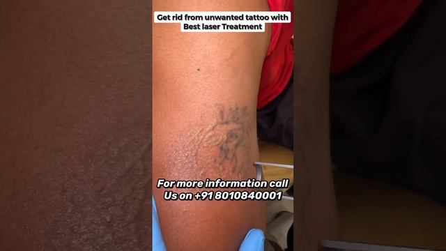 World’s best laser for Tattoo Removal Treatment at Dr  Kasana’s Clinic