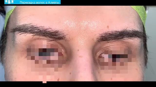 WHAT IS AN EYELASH TRANSPLANT?