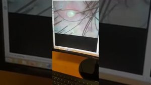 Гнойники на коже головы