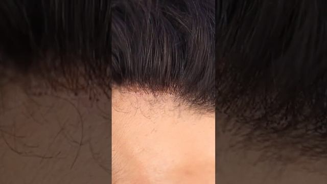 #hairfixinginbangalore | most Natural Hairline Hair patch| #Arthahairfixing Call 9110221804