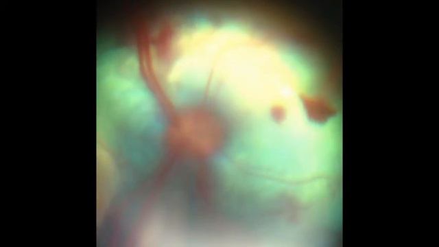 отслойка смотреть онлайн