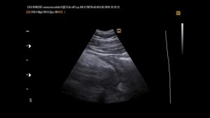 Аппендикулярный инфильтрат на УЗИ(12-2-18)