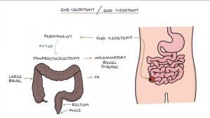 Understanding Stomas (Colostomy, Ileostomy, Urostomy and Gastrostomy)