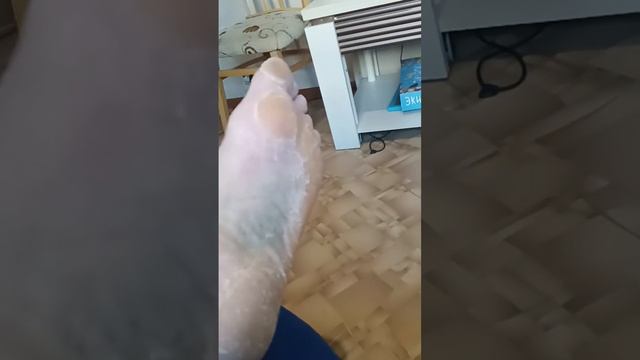 перелом пяточной кости смотреть онлайн