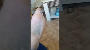 перелом пяточной кости