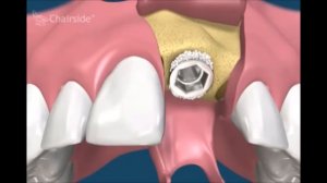 Немедленная имплантация сразу после удаление зуба Имплантология Стоматология