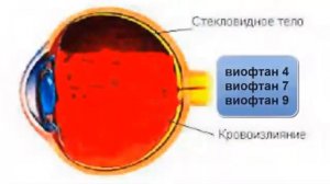 Кровоизлияние в стекловидное тело глаза и как справиться с этим при помощи виофтанов