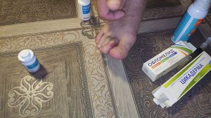 Лечение ожога от сварки на ногах