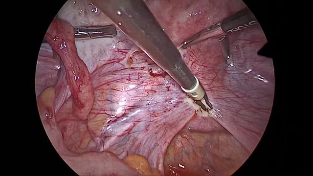 Лапароскопия: иссечение и термодеструкция очагов эндометриоза смотреть онлайн
