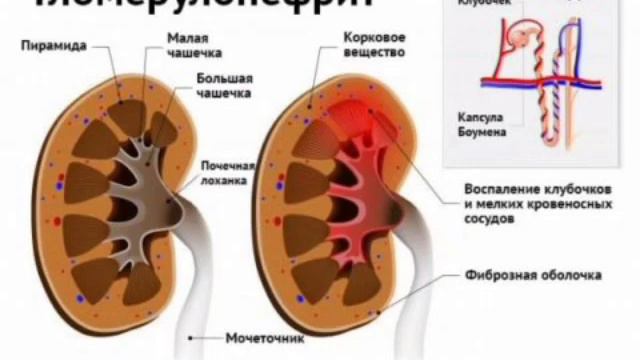 Гломерулонефрит Нефрон смотреть онлайн
