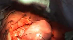 Хирургический гемостаз  Гемостатический компрессионный шов по методике B Lynch