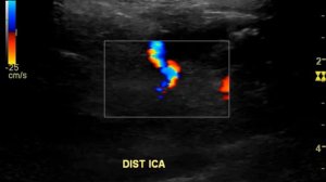CAROTID DUPLEX CCA TO SUBCLAVIAN ARTERY BYPASS
