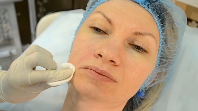 Контурная пластика, как убрать носогубные складки - понятная косметология #14 смотреть онлайн