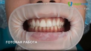 Установка виниров. Реальные работы До и После.