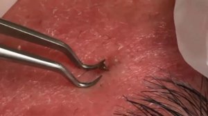 Удаление черных точек 2021